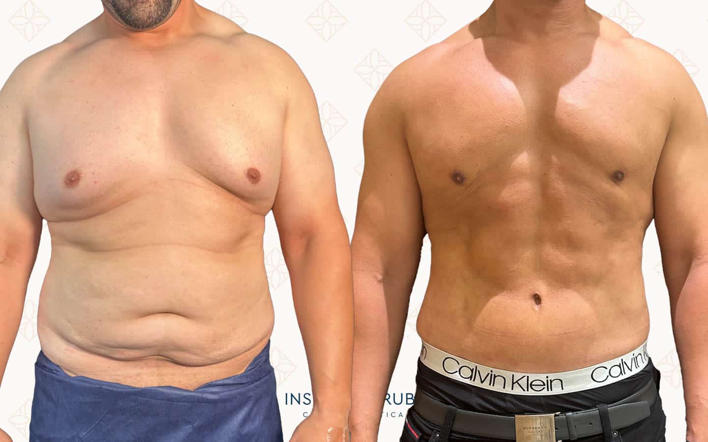 Antes y después lipoescultura Instituto Rubí — Lipoescultura corporal + lipofilling glúteo · Vista frontal