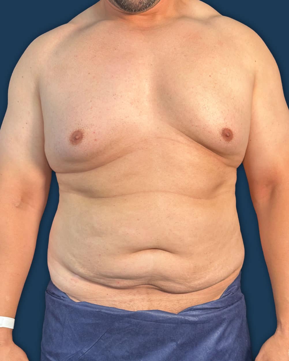 Antes y después lipoescultura Instituto Rubí — Lipoescultura de cintura y espalda · Vista 1