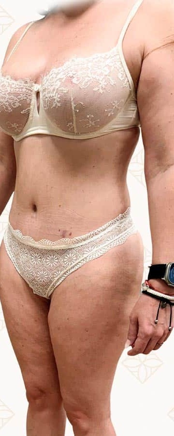 Después lipoescultura Instituto Rubí — Marcación abdominal HD