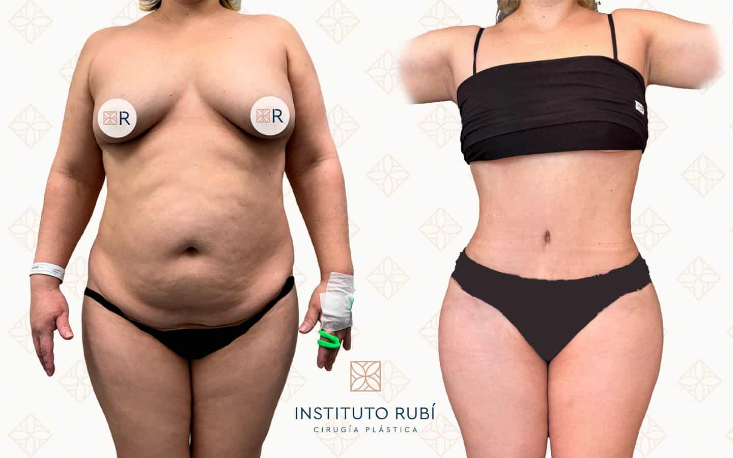 Antes y después lipoescultura Instituto Rubí — Remodelación corporal completa · Técnica de lipoescultura propia · Vista frontal