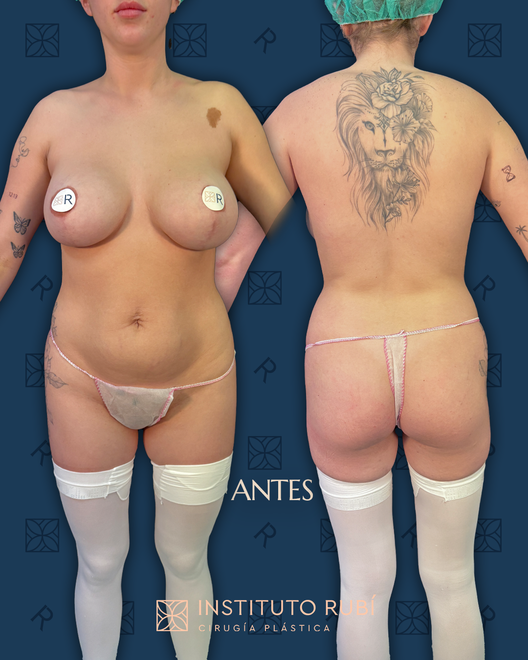 Resultado de la lipoescultura 360 de Judith Arias