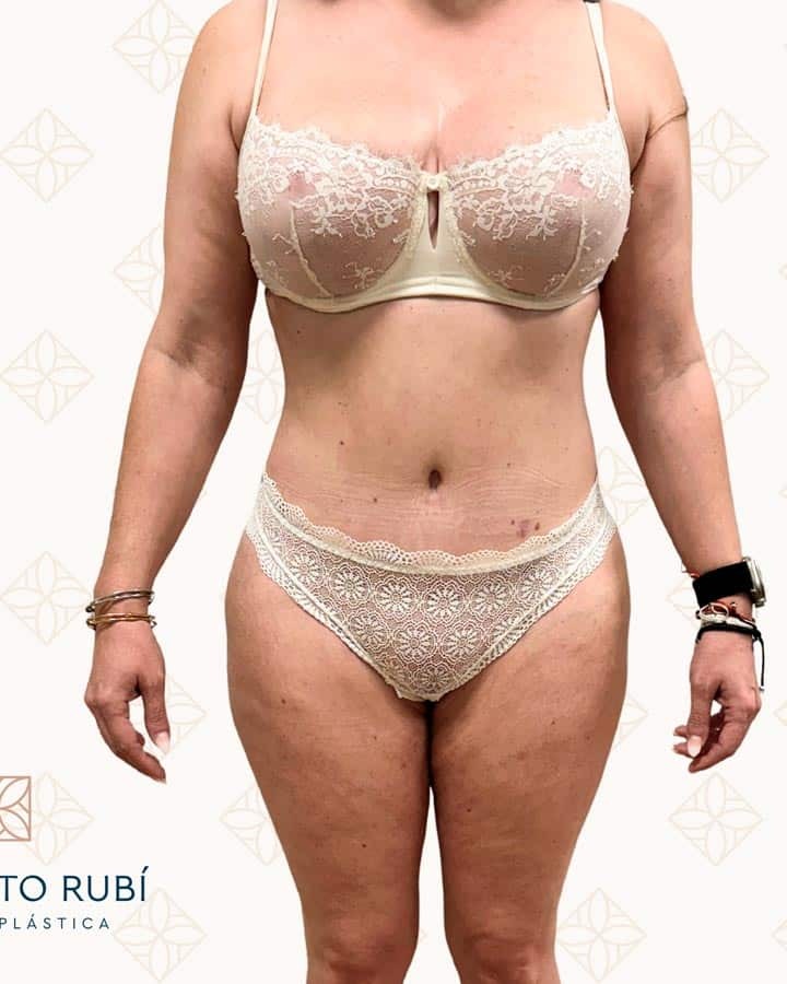 Después lipoescultura Instituto Rubí — Lipoescultura de espalda y cintura