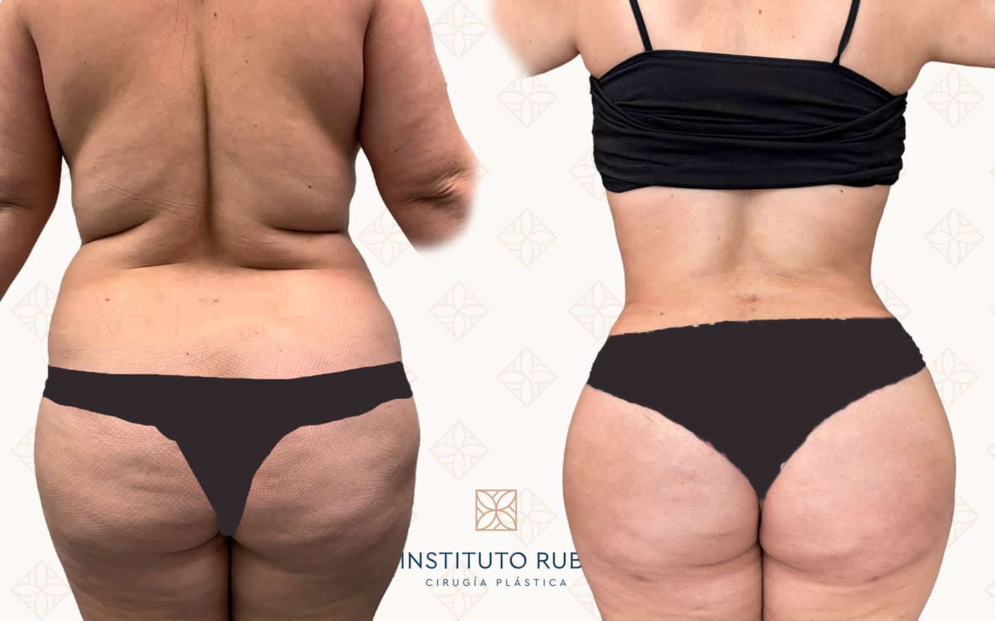 Antes y después lipoescultura Instituto Rubí — Remodelación corporal completa · Técnica de lipoescultura propia · Vista posterior