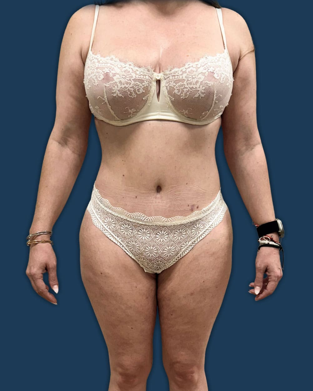 Después lipoescultura Instituto Rubí — Lipoescultura abdomen + flancos