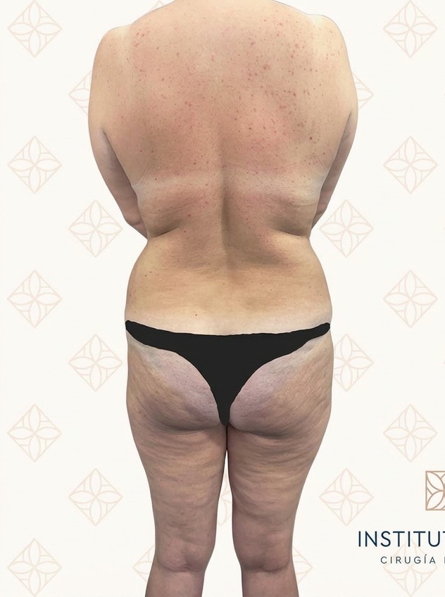 Antes lipoescultura Instituto Rubí — Lipoescultura 360° femenina