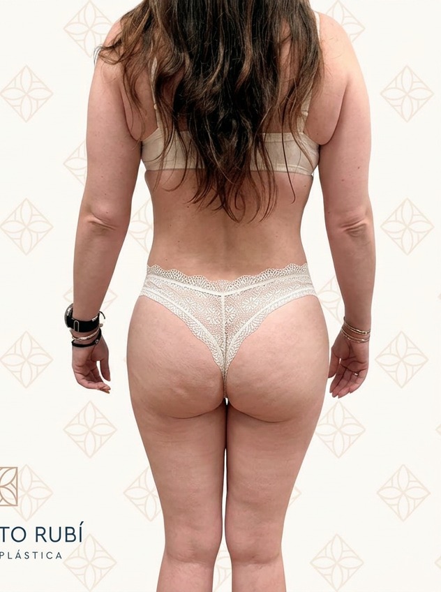 Después lipoescultura Instituto Rubí — Lipoescultura 360° femenina