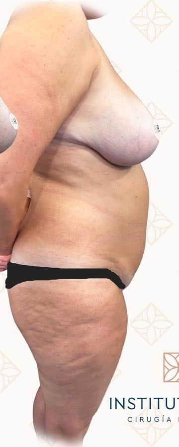Antes lipoescultura Instituto Rubí — Lipofilling glúteo (BBL)