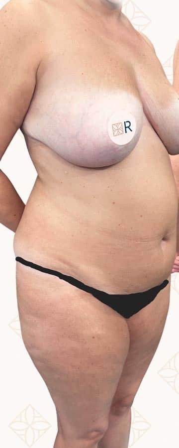 Antes lipoescultura Instituto Rubí — Marcación abdominal HD