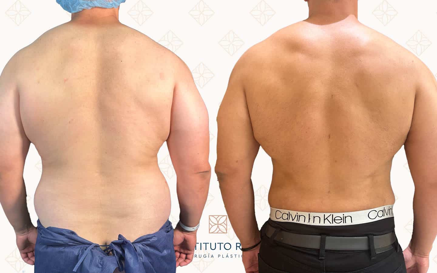 Antes y después lipoescultura Instituto Rubí — Lipoescultura corporal + lipofilling glúteo · Vista posterior
