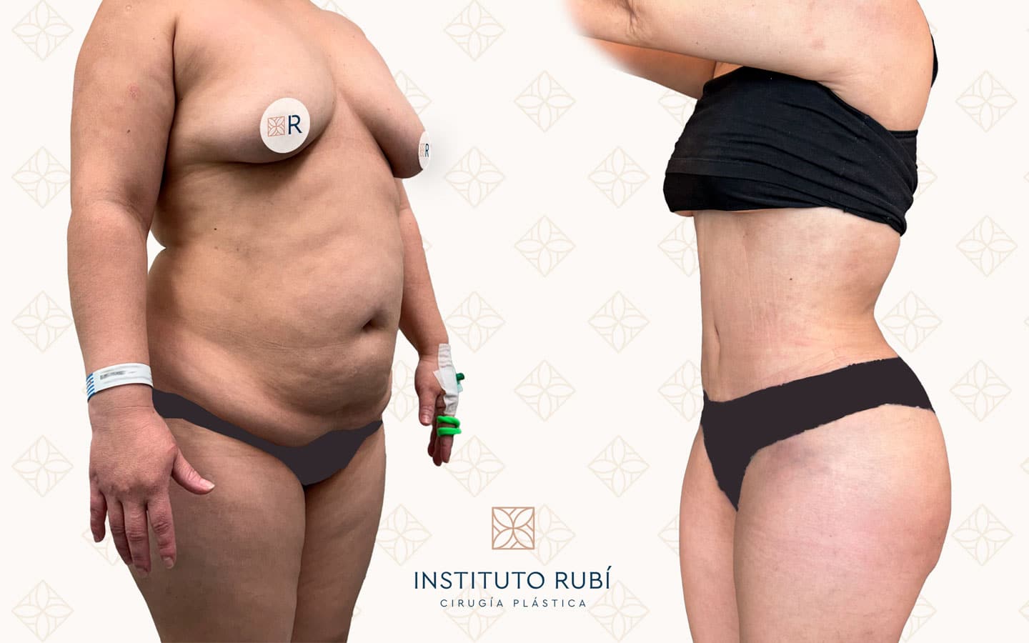 Antes y después lipoescultura Instituto Rubí — Remodelación corporal completa · Técnica de lipoescultura propia · Vista lateral